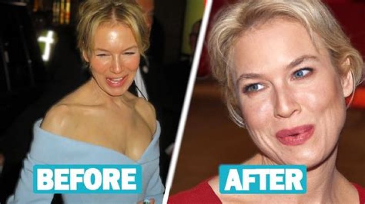 Unveiling The Secrets Of Rene Zellweger's Transformative Journey: Cosmetic Surgery Insights